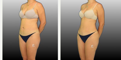 Liposuction before and after photo