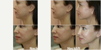 Neck Lift before and after photo