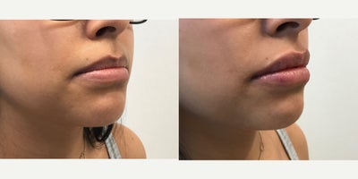 Restylane before and after photo