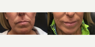 Volbella before and after photo