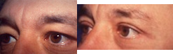 Eyelid Surgery before and after photo