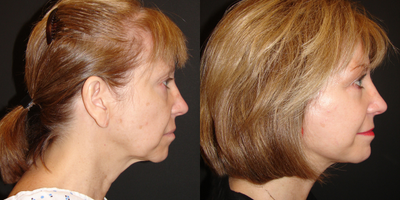 Facelift before and after photo