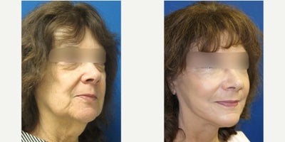 Facelift before and after photo