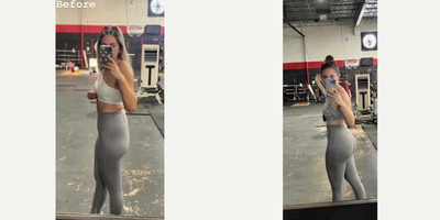 Liposuction before and after photo