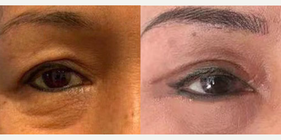 Thread Lift before and after photo