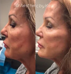 Voluma before and after photo