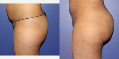 Brazilian Butt Lift before and after photo