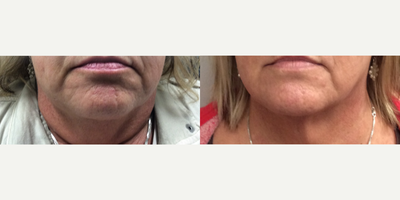 CoolSculpting before and after photo