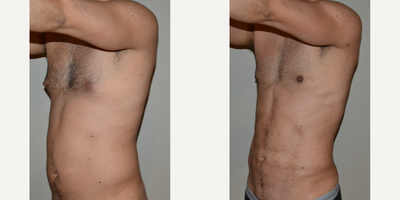 Gynecomastia Surgery before and after photo