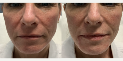 Restylane Defyne before and after photo