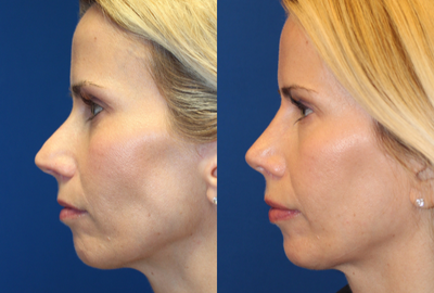 Rhinoplasty before and after photo