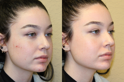 Voluma before and after photo