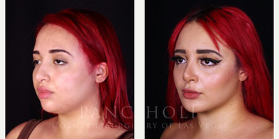 Buccal Fat Removal before and after photo