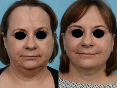 Facelift before and after photo