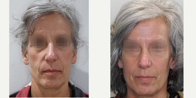 PRP Injections before and after photo