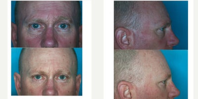 Eyelid Surgery before and after photo