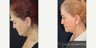 Facelift before and after photo