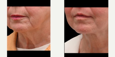 Neck Lift before and after photo