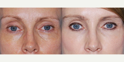 Nonsurgical Facelift before and after photo