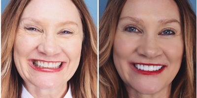 Porcelain Veneers before and after photo