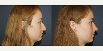 Rhinoplasty before and after photo
