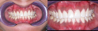 Teeth Whitening before and after photo