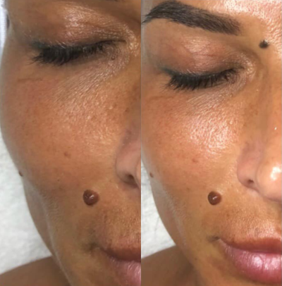 DiamondGlow before and after photo
