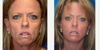 Facelift before and after photo