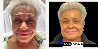 Facelift before and after photo