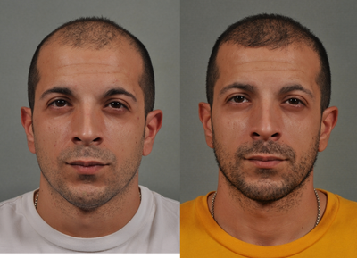 Hair Transplant before and after photo