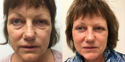 Eyelid Surgery before and after photo