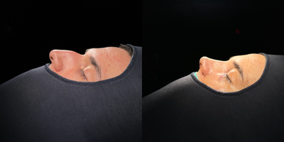 Nonsurgical Nose Job before and after photo