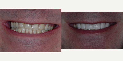 Porcelain Veneers before and after photo