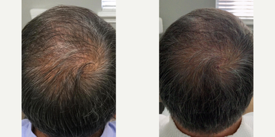 PRP for Hair Loss before and after photo