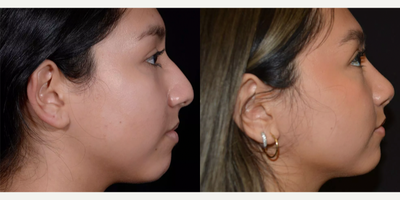 Rhinoplasty before and after photo