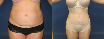Tummy Tuck before and after photo