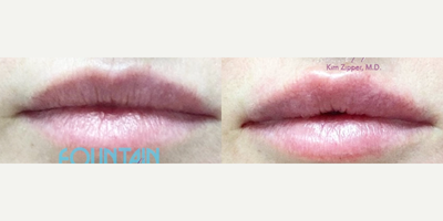 Volbella before and after photo