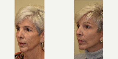 Brow Lift before and after photo