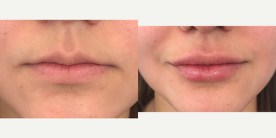 Lip Fillers before and after photo