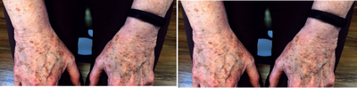 IPL before and after photo