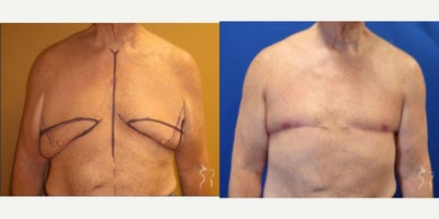 Breast Lift before and after photo