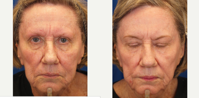 CO2 Laser before and after photo