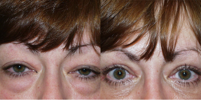 Eyelid Surgery before and after photo