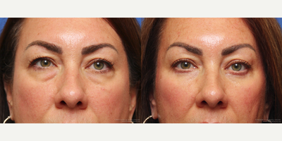Eyelid Surgery before and after photo