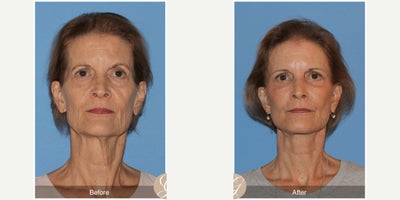 Facial Fat Transfer before and after photo