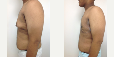 Gynecomastia Surgery before and after photo
