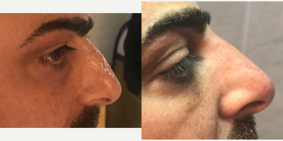 Nonsurgical Nose Job before and after photo