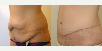 Tummy Tuck before and after photo