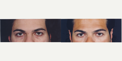 Eyelid Surgery before and after photo