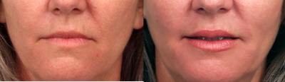 Facial Fat Transfer before and after photo